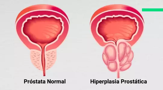 Hiperplasia prostática benigna (HPB)