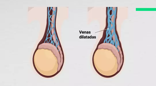 Varicocele venas dilatadas