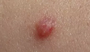 Verrugas genitales