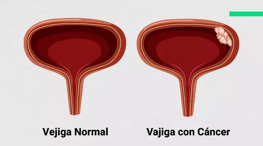 Cáncer de vejiga