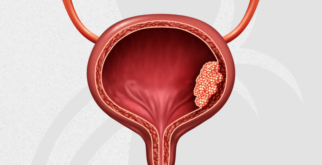 Cáncer de Vejiga; sangre en la orina, una señal temprana
