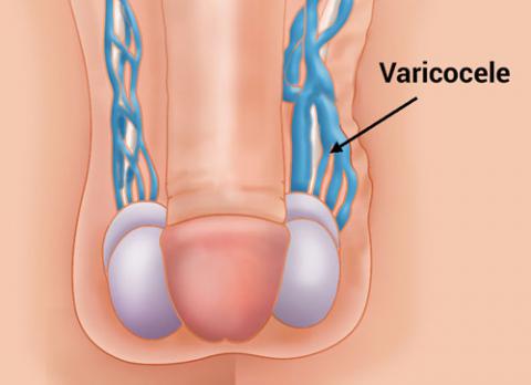 varicocele y la infertilidad, dilatación anormal de las venas en el escroto