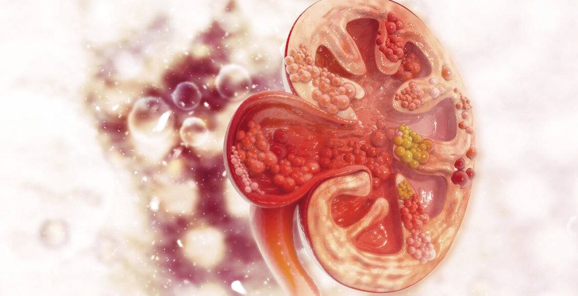 Fiestas sin Dolor: Estrategias para Evitar Crisis de Cálculos Renales