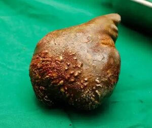 Urología avanzada en Tijuana: Cálculos renales